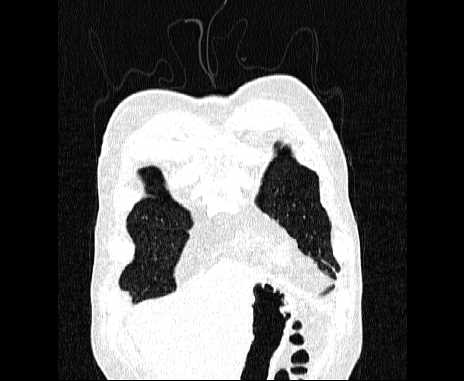 Centrilobular pulmonary emphysema (Radiopaedia 62468-70718 Coronal lung window 9).jpg