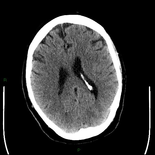 Cerebellar abscess (Radiopaedia 78135-90671 Axial non-contrast 67).jpg