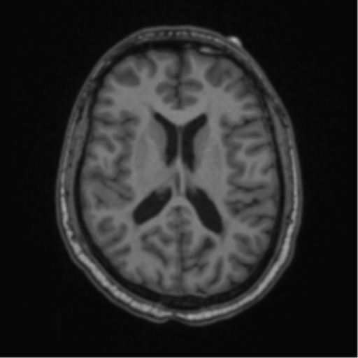 Cerebellar hemangioblastomas and pituitary adenoma (Radiopaedia 85490-101176 Axial T1 43).png