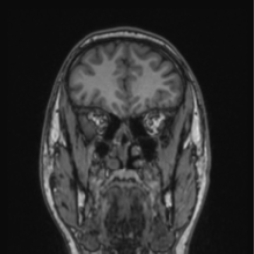 Cerebellar hemangioblastomas and pituitary adenoma (Radiopaedia 85490-101176 Coronal T1 69).png