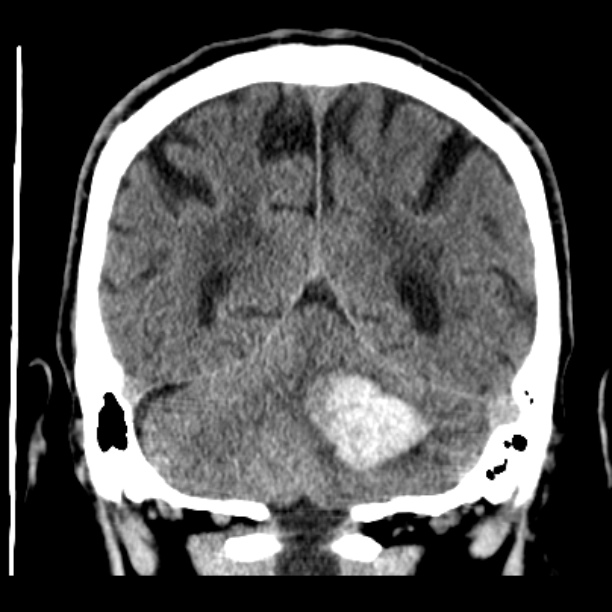 Cerebellar hemorrhage (Radiopaedia 27193-27359 Coronal non-contrast 42).jpg