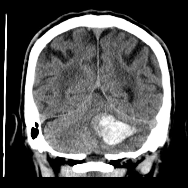 Cerebellar hemorrhage (Radiopaedia 27193-27359 Coronal non-contrast 43).jpg