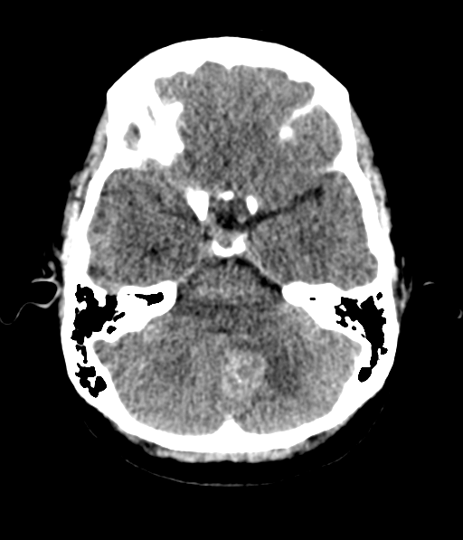 Cerebellar metastases - colorectal adenocarcinoma (Radiopaedia 40947-43652 Axial non-contrast 17).png