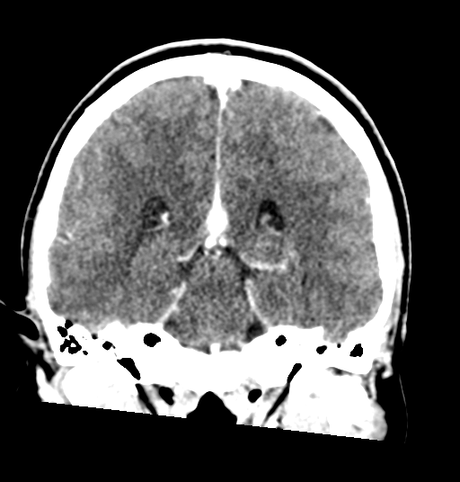 Cerebellar metastases - colorectal adenocarcinoma (Radiopaedia 40947-43652 Coronal C+ 56).png