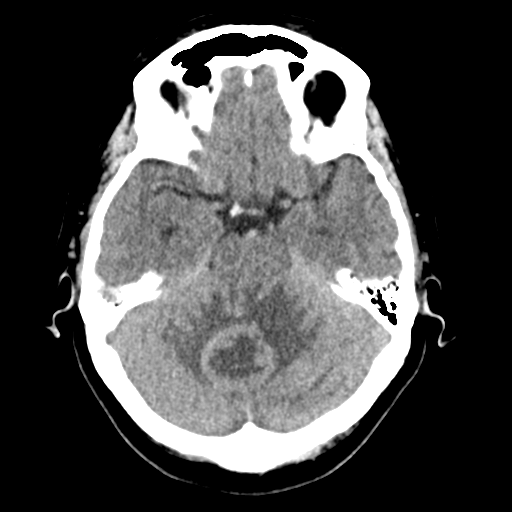 File:Cerebellar metastasis (Radiopaedia 54578-60812 Axial non-contrast 16).png