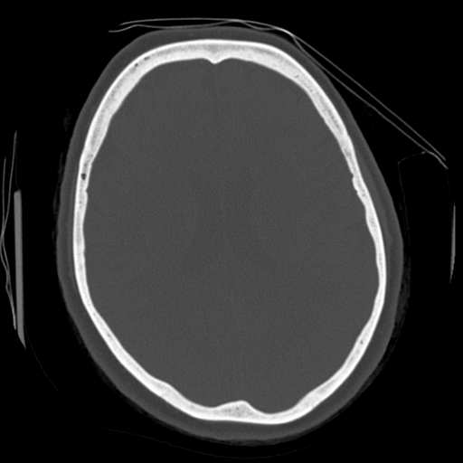Cerebellar metastasis (cystic appearance) (Radiopaedia 41395-44258 Axial bone window 42).png