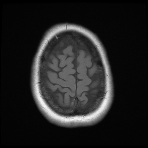 File:Cerebellar metastasis (cystic appearance) (Radiopaedia 41395-44268 Axial T1 21).png