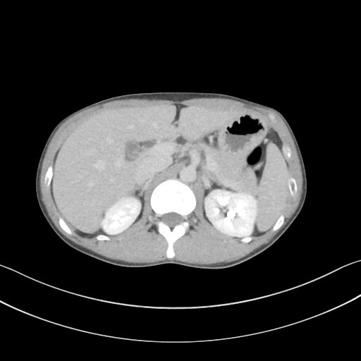 Cerebellar metastasis - adenocarcinoma lung (Radiopaedia 63184-71717 Axial C+ delayed 71).png
