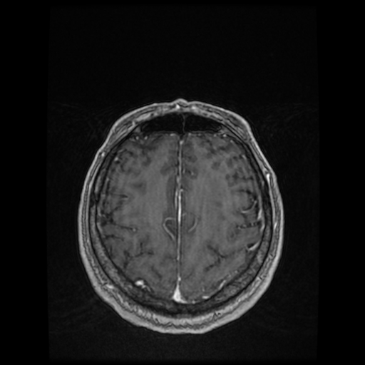 Cerebellar metastasis of pulmonary adenocarcinoma, cavernous venous malformation, and developmental venous anomaly (Radiopaedia 85827-101661 Axial T1 C+ 72).jpg