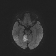File:Cerebellar stroke (Radiopaedia 32202-33150 Axial DWI 32).png