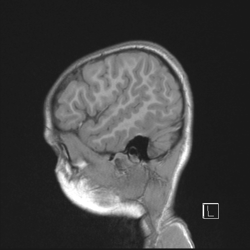Cerebellar stroke (Radiopaedia 32202-33150 Sagittal T1 C+ 8).png
