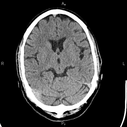 File:Cerebellopontine angle arachnoid cyst (Radiopaedia 85149-100704 Axial With contrast 22).jpg