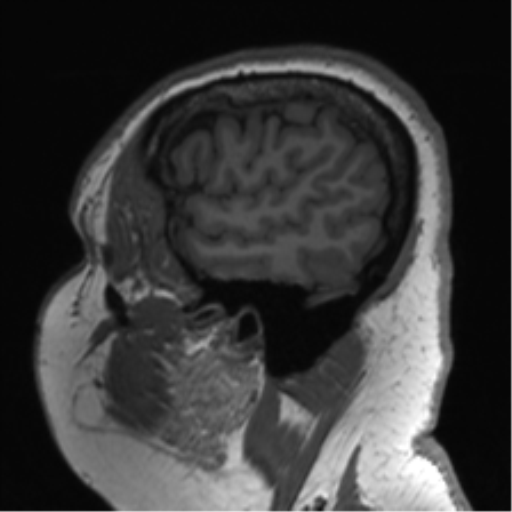 Cerebellopontine angle meningioma (Radiopaedia 48434-53348 Sagittal T1 76).png