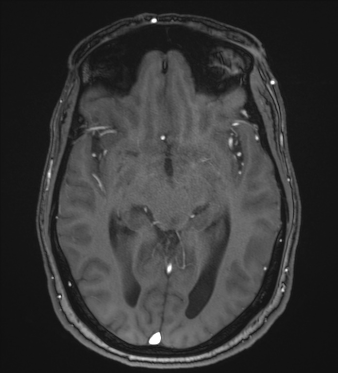 Cerebellopontine angle meningioma (Radiopaedia 72983-83680 Axial MRA 56).jpg