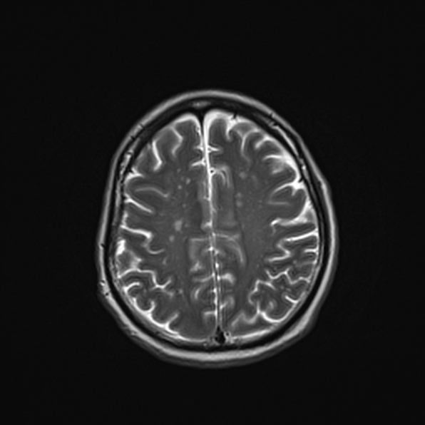 Cerebral abscess (Radiopaedia 26111-26247 Axial T2 45).jpg