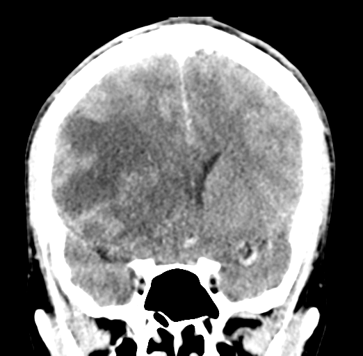 File:Cerebral abscess (Radiopaedia 60342-68008 Coronal C+ delayed 26).png
