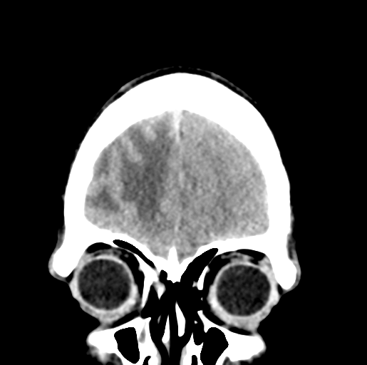 Cerebral abscess (Radiopaedia 60342-68008 Coronal non-contrast 9).png