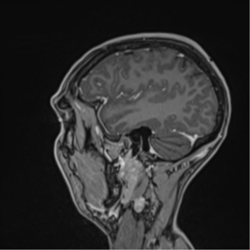 Cerebral abscess (Radiopaedia 60342-68009 J 15).png