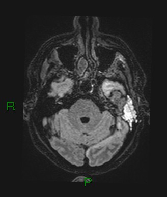 File:Cerebral abscess and subdural empyema (Radiopaedia 84436-99779 Axial FLAIR 62).jpg