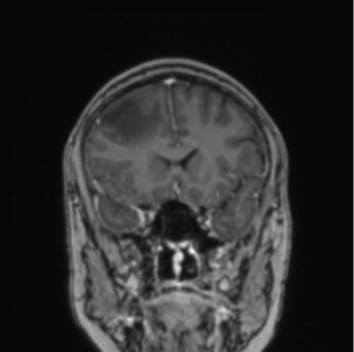 Cerebral abscess from pulmonary arteriovenous malformation (Radiopaedia 86275-102291 L 61).png