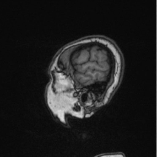 Cerebral abscess from pulmonary arteriovenous malformation (Radiopaedia 86275-102291 Sagittal T1 23).png
