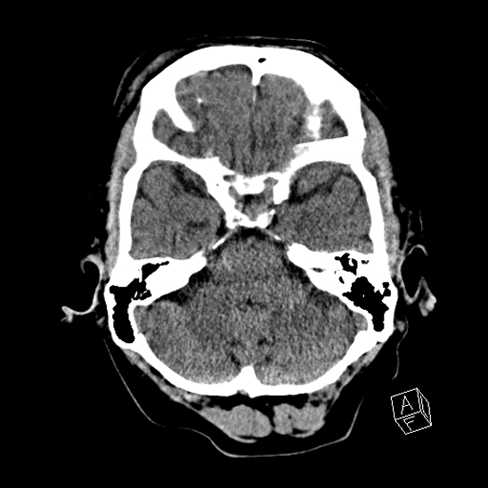 Cerebral abscess with ventriculitis (Radiopaedia 78965-91876 Axial non-contrast 15).jpg