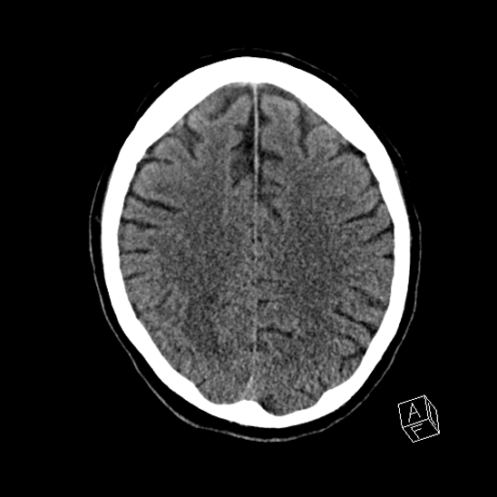 Cerebral abscess with ventriculitis (Radiopaedia 78965-91876 Axial non-contrast 34).jpg