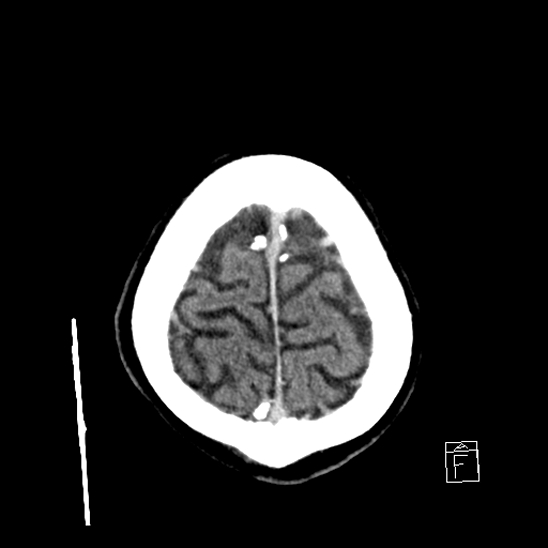 File:Cerebral abscess with ventriculitis (Radiopaedia 78965-91877 A 43).jpg