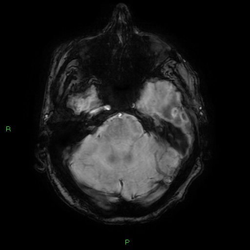 File:Cerebral amyloid angiopathy-associated lobar intracerebral hemorrhage (Radiopaedia 58376-65512 Axial SWI 17).jpg