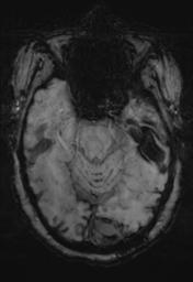 File:Cerebral amyloid angiopathy (Radiopaedia 29129-29518 Axial SWI MPR 11).jpg