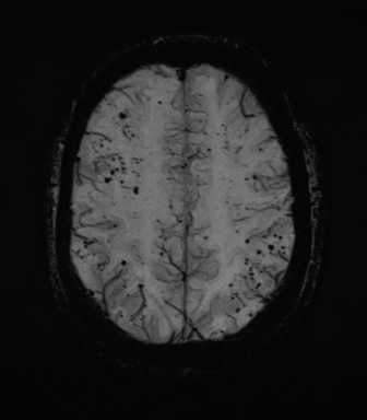 Cerebral amyloid angiopathy (Radiopaedia 46082-50433 Axial SWI MIP 58).png