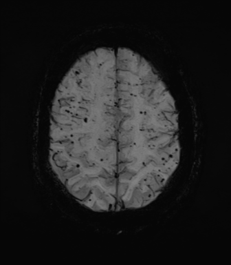 Cerebral amyloid angiopathy (Radiopaedia 46082-50433 Axial SWI MIP 62).png