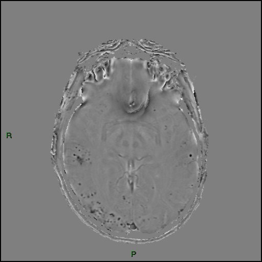 Cerebral amyloid angiopathy (Radiopaedia 77506-89664 H 49).jpg