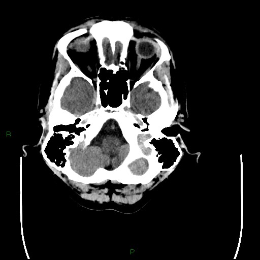 Cerebral amyloid angiopathy (Radiopaedia 77506-89665 Axial non-contrast 18).jpg