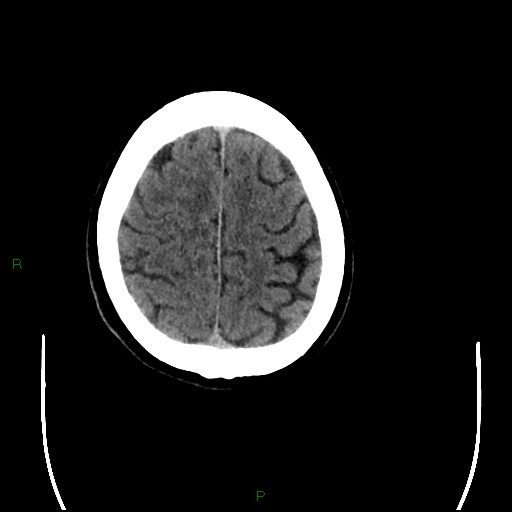 File:Cerebral amyloid angiopathy (Radiopaedia 77506-89665 Axial non-contrast 92).jpg