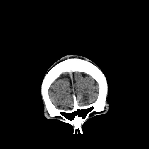 Cerebral arteriovenous malformation (Radiopaedia 61964-70028 Coronal non-contrast 6).jpg