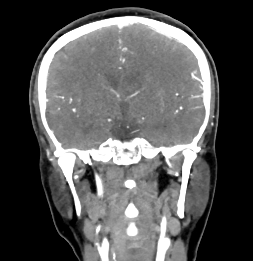 Cerebral arteriovenous malformation (Radiopaedia 73830-84645 C 49).jpg