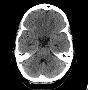 File:Cerebral arteriovenous malformation (Radiopaedia 74411-85744 Axial non-contrast 9).jpg