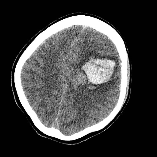 Cerebral arteriovenous malformation (Radiopaedia 79677-92887 Axial non-contrast 29).jpg