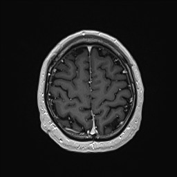 Cerebral arteriovenous malformation (Radiopaedia 84015-99245 Axial T1 C+ 128).jpg