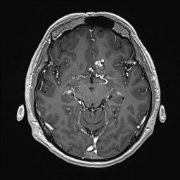 Cerebral arteriovenous malformation (Radiopaedia 84015-99245 Axial T1 C+ 69).jpg