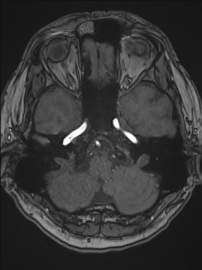 File:Cerebral arteriovenous malformation (Radiopaedia 84015-99245 Axial TOF 71).jpg