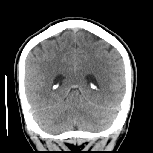 Cerebral arteriovenous malformation (Spetzler-Martin grade 2) (Radiopaedia 41262-44076 Coronal non-contrast 46).png