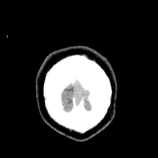Cerebral arteriovenous malformation (Spetzler-Martin grade 2) (Radiopaedia 41262-44076 Coronal non-contrast 64).png