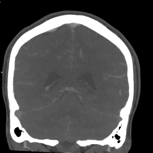Cerebral arteriovenous malformation (Spetzler-Martin grade 2) (Radiopaedia 41262-44076 F 45).png