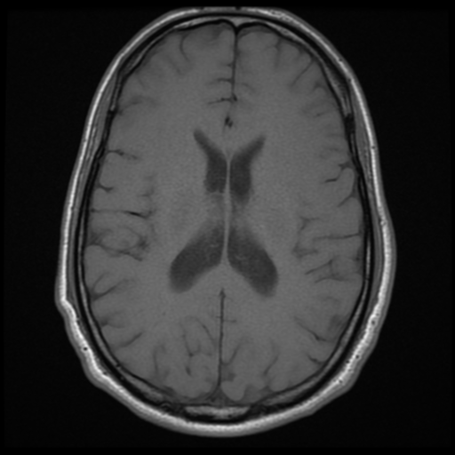 File:Cerebral arteriovenous malformation (Spetzler-Martin grade 2) (Radiopaedia 41262-44092 Axial T1 12).png