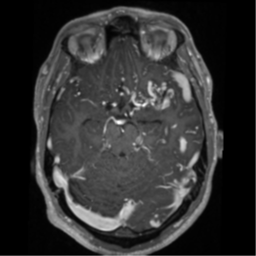 Cerebral arteriovenous malformation - huge (Radiopaedia 35734-37272 Axial T1 C+ 25).png