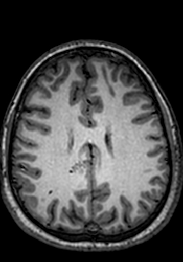 File:Cerebral arteriovenous malformation at posterior body of corpus callosum (Radiopaedia 74111-84925 Axial T1 94).jpg