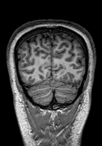 Cerebral arteriovenous malformation at posterior body of corpus callosum (Radiopaedia 74111-84925 Coronal T1 304).jpg