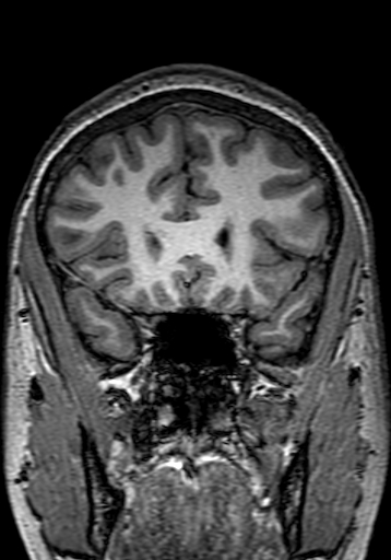 File:Cerebral arteriovenous malformation at posterior body of corpus callosum (Radiopaedia 74111-84925 Coronal T1 88).jpg